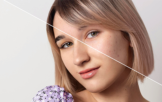 Microneedling Aftercare Tips for Optimal Results